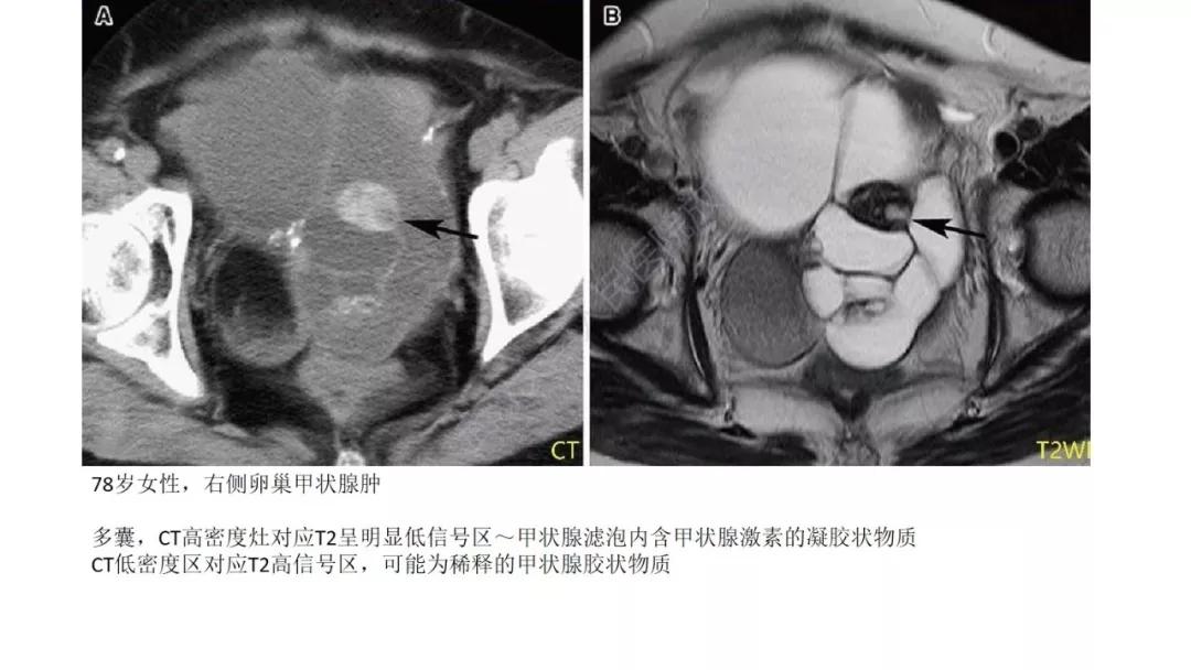 卵巢原发肿瘤的分析思路