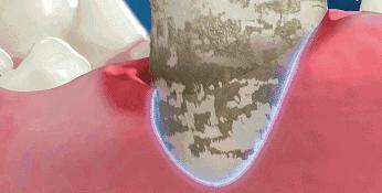 一张嘴就闻到牙臭味怎么办,一张嘴就恶臭怎么回事