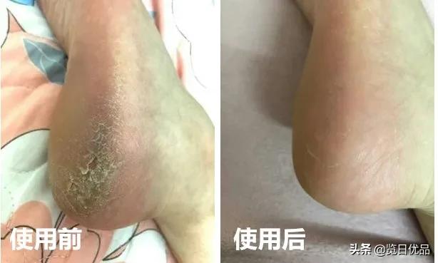 爽炸了！干丑裂的脚皮，一张完整撕掉，敢跟婴儿比姣嫩！