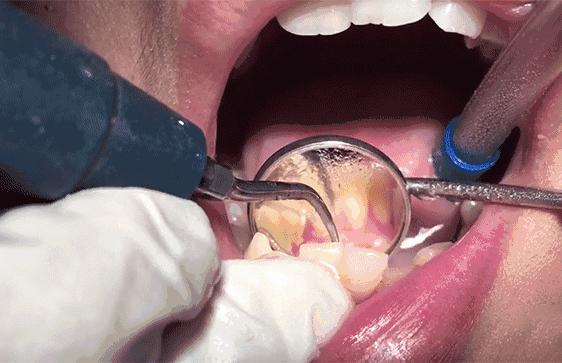 洗牙后牙齿变敏感怎么办,洗牙两周牙齿出血敏感