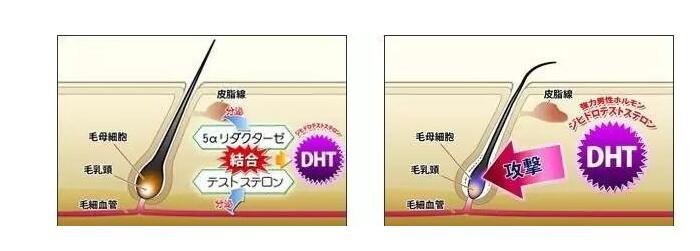 脂溢性脱发和脂溢性皮炎是同一种原因？是一回事？