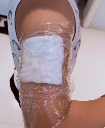 肌注部位红肿疼痛起硬结怎么处理,肌注部位及方法