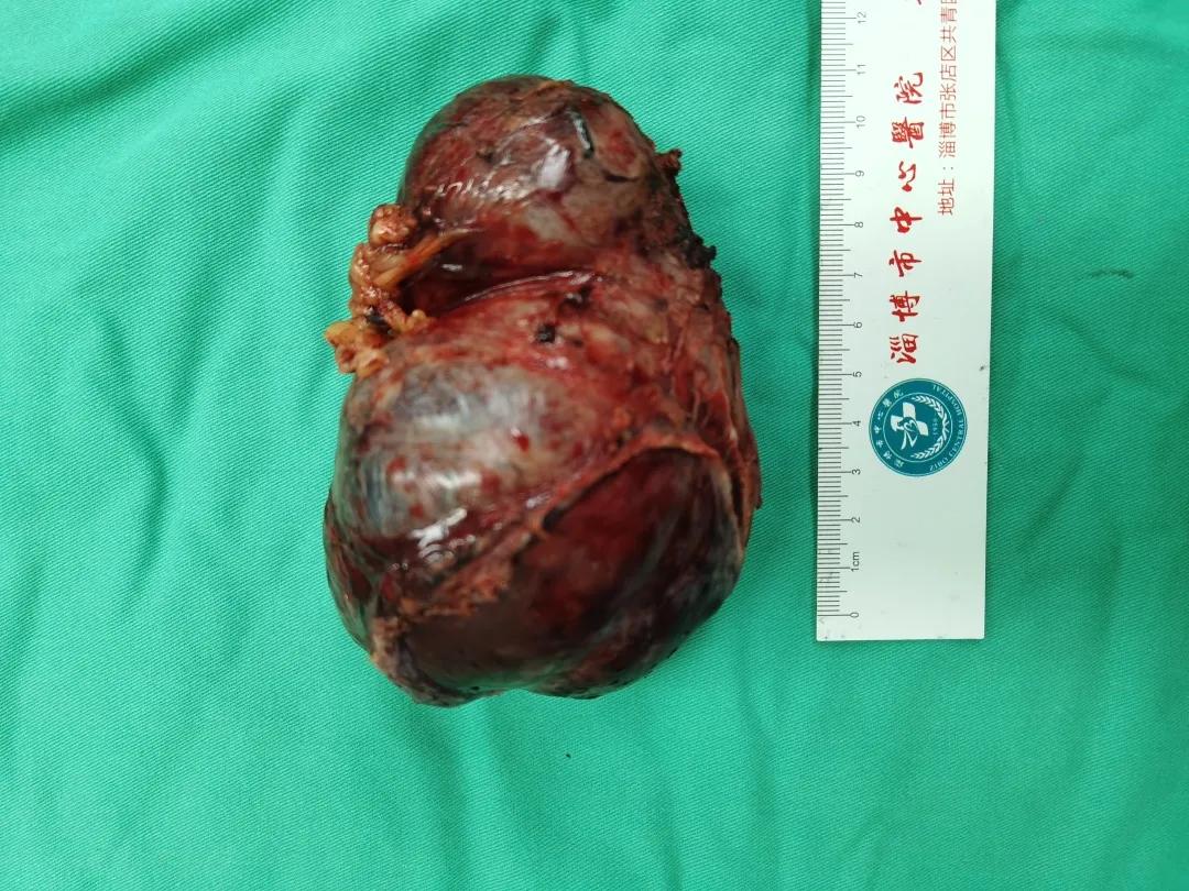 微创手术切除肠道肿瘤,中心医院切胃手术