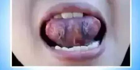 有淤血是什么颜色,有淤血才会出血是什么原理