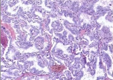 甲状腺术后要终生吃优甲乐吗,甲状腺全切终生服用优甲乐