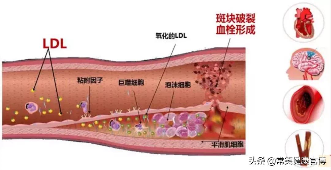 得了高胆固醇血症怎么办,高胆固醇血症有五个表现症状