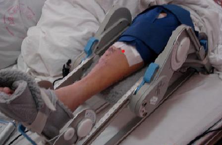 带你了解骨科术后康复,骨科早期康复介入