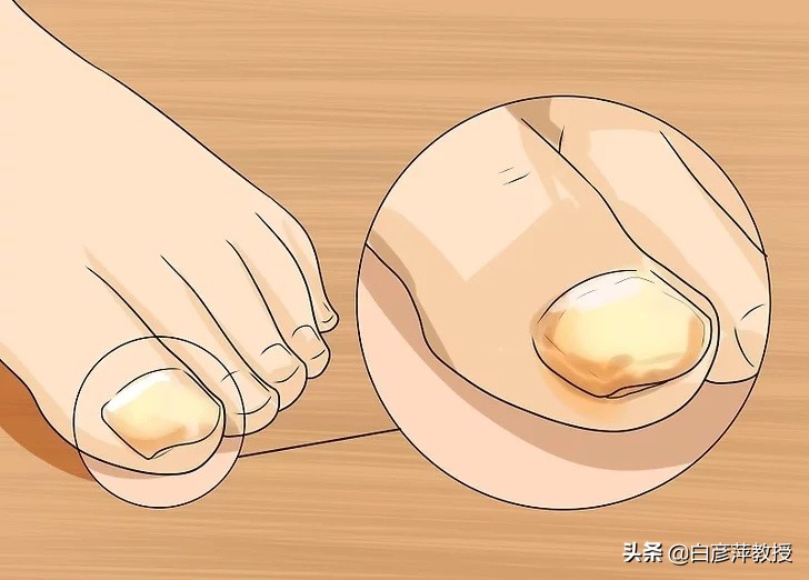 灰指甲是真菌怕晒吗,灰指甲一定是灰色的吗