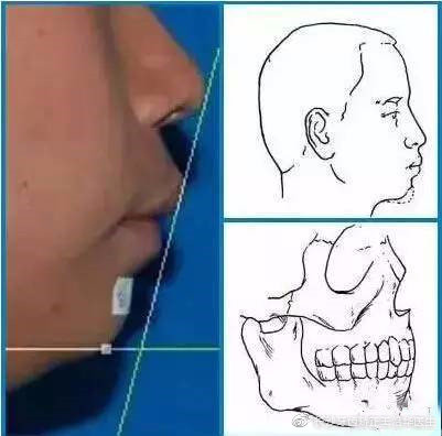 下巴短小怎么办不整容可以改变吗,下巴短后缩下颌线不明显怎么改善