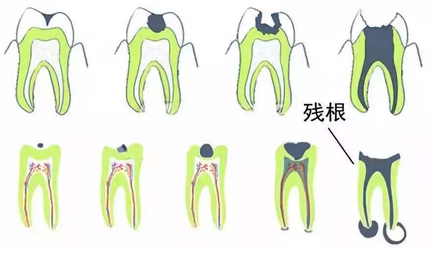 牙齿缺失牙根还在的最佳修复方法,缺失一颗牙齿可以拔掉不修复吗