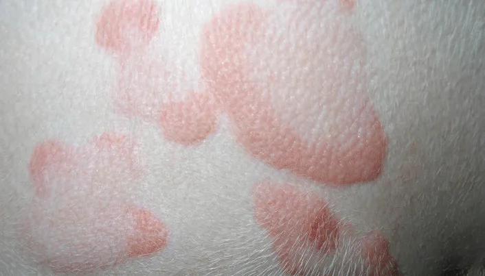 *麻疹荨**忌口了就能好吗？其实很多人都错了