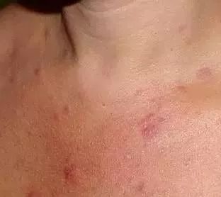 祛除闭合性粉刺软膏有哪些,下巴有闭合性粉刺怎么祛除