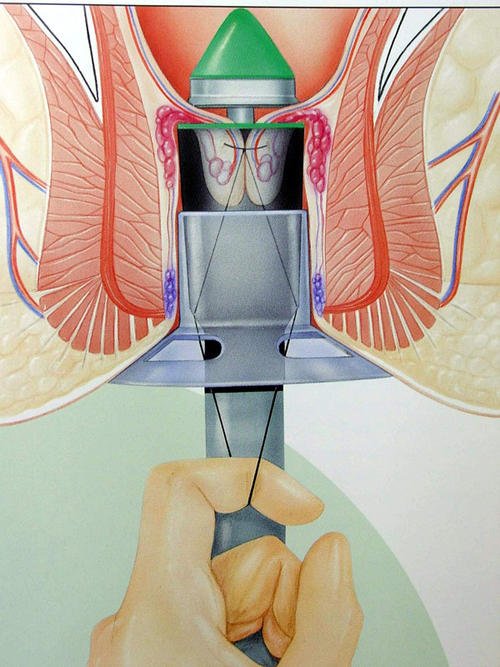 痔疮如何对症用药,肛肠科专家谈痔疮