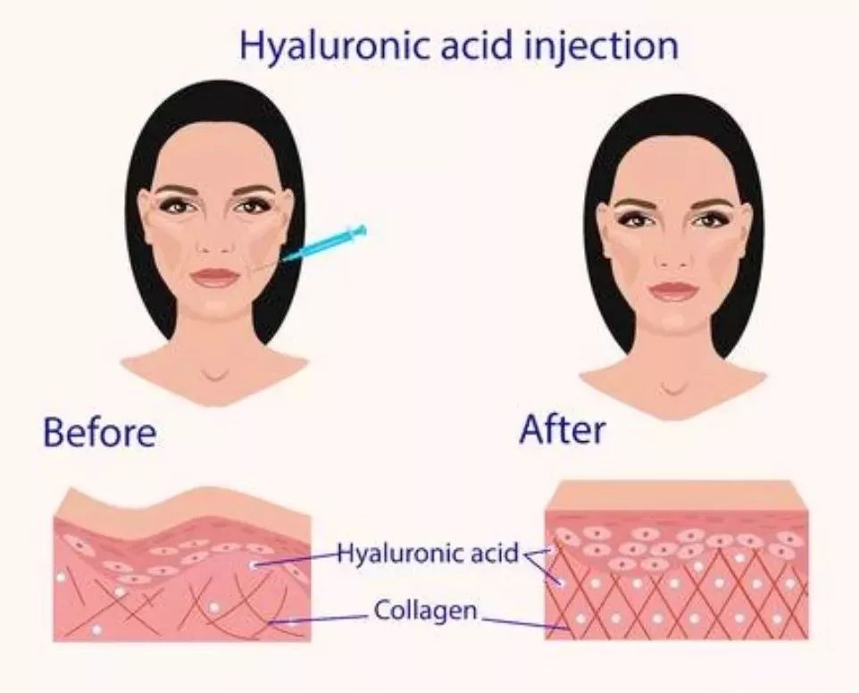 正确认识一下玻尿酸到底有啥功效,请收好这篇玻尿酸全面科普文章