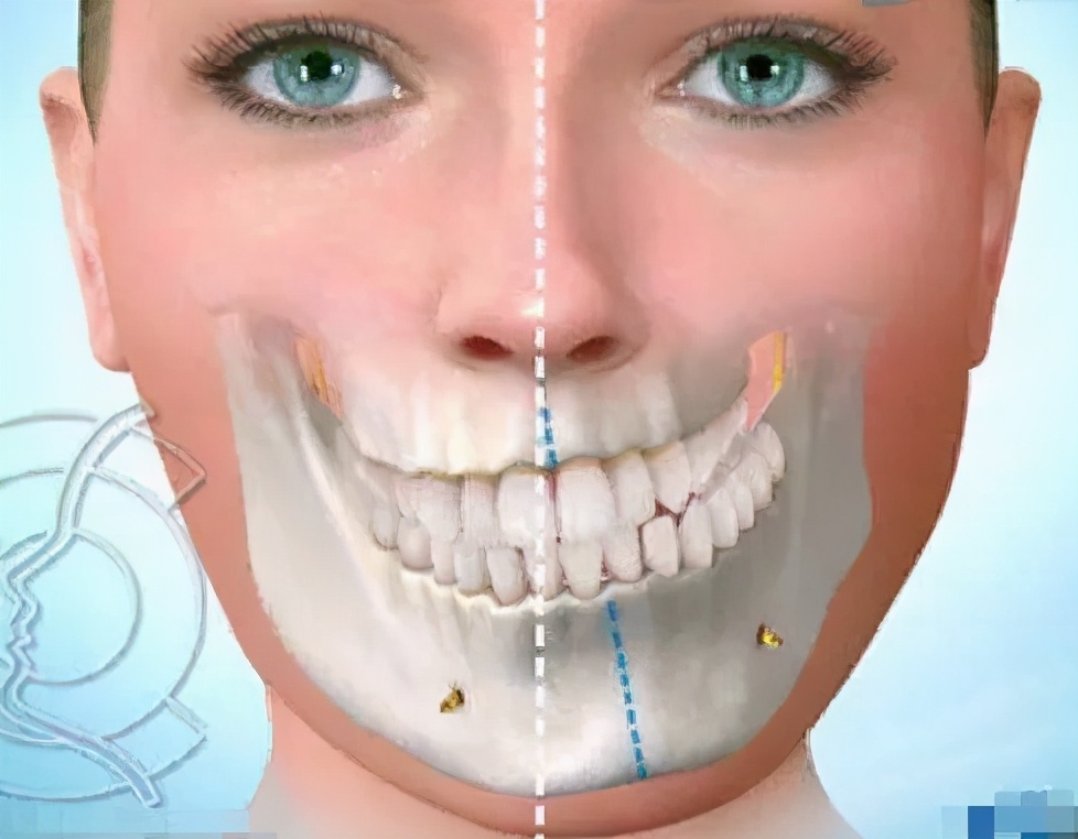 不想做正颌手术怎么改善嘴突,脸不对称挂号正畸还是正颌