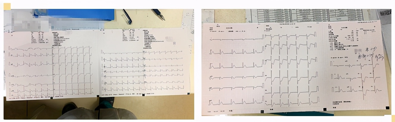 急性心肌梗塞的急救与护理措施,心内科抢救