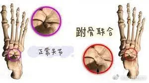 关注足踝知识普及与宣教,儿童足踝健康科普