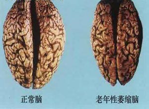弥漫性脑萎缩有什么危害,脑萎缩的危害视频