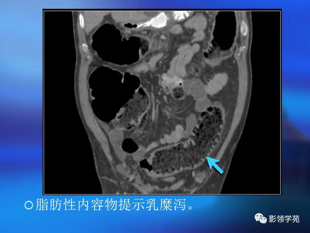 肠道内壁增厚,肠道扩张ct表现