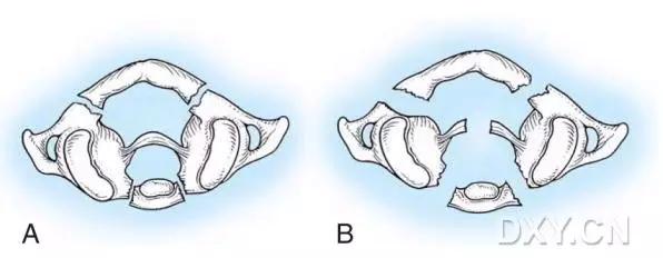 所有骨折都叫什么名字,骨折的名称有哪些