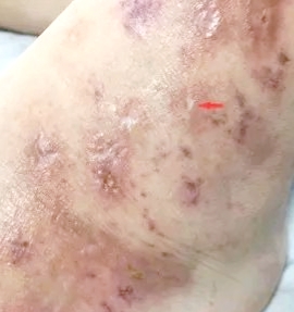 小腿上黑色疤痕怎么回事,小腿上的一个疤痕发黑