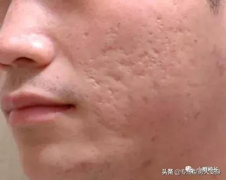 祛痘印最好的方法目前最有效,祛痘印的东西怎么用