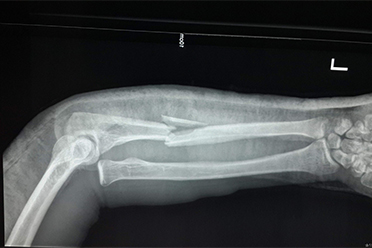 严重创伤骨折现场急救的重要性,儿童骨折如何进行现场处理