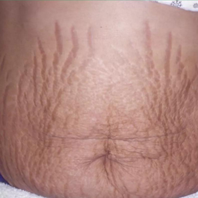 医生推荐防妊娠纹,搞定妊娠纹几十块钱就够了