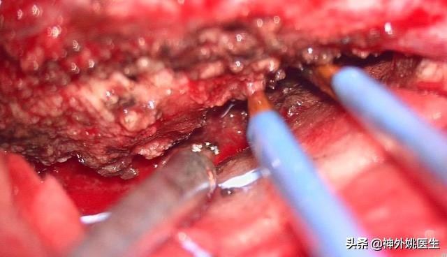 脑膜瘤是什么原因引起的啊,脑膜瘤手术治疗全部大概多少钱