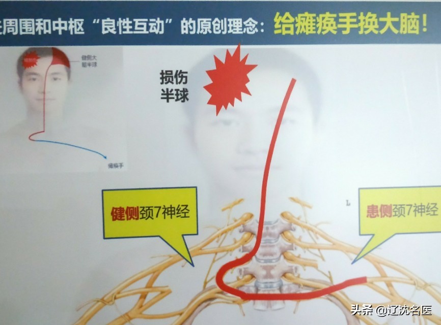 脑血栓老人胳膊挎筐,偏瘫患者挎筐恢复