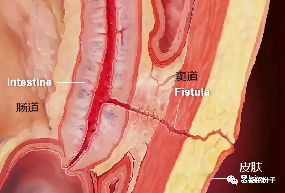 肠子漏了一个洞,肠漏是肠子漏了吗