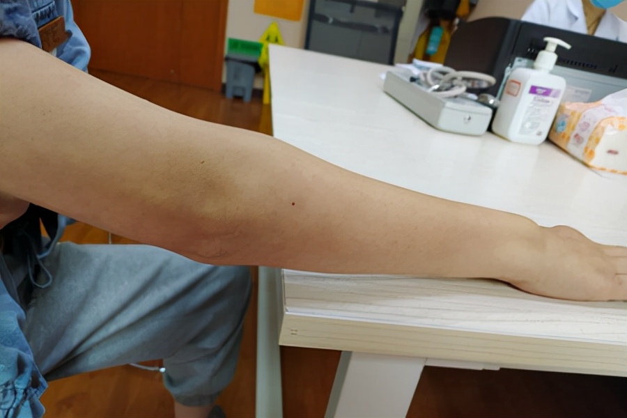 按时吃药，类风湿还是加重了，都是贫血惹的祸