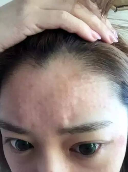 把水光针当饭吃？这位网红简直丧心病狂！整容后年入千万