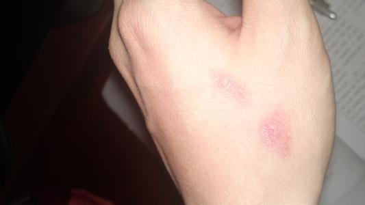 被烫伤是敷牙膏好还是酱油好,身上有烫伤疤痕可以试药吗