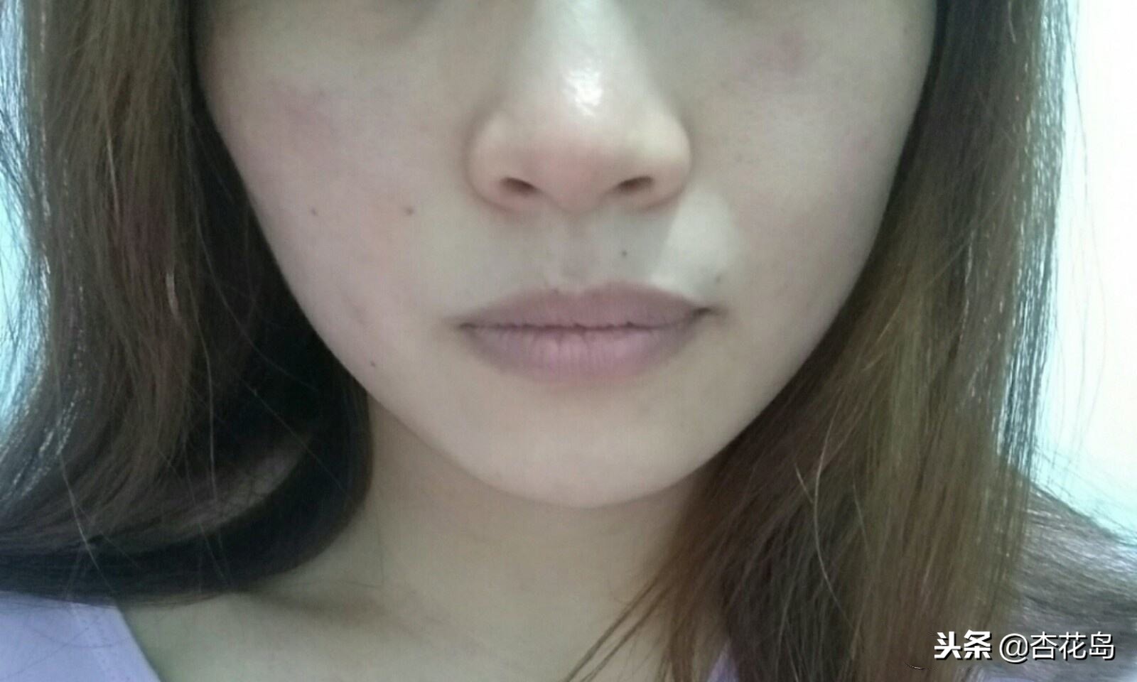 皮肤干燥又油怎么办,皮肤外油内干是什么原因引起的