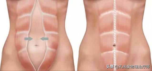 孕妈妈产后为什么会腰痛,产后三个月的宝妈腰酸腰疼咋回事