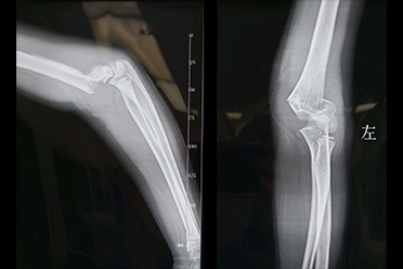 孩子骑滑板车摔伤的视频,摔倒后胳膊抬不起来怎么办无骨折