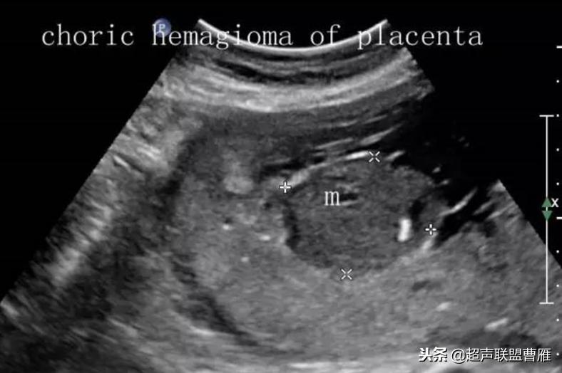 胎盘绒毛膜血管瘤是什么引起的,胎盘绒毛膜血管瘤
