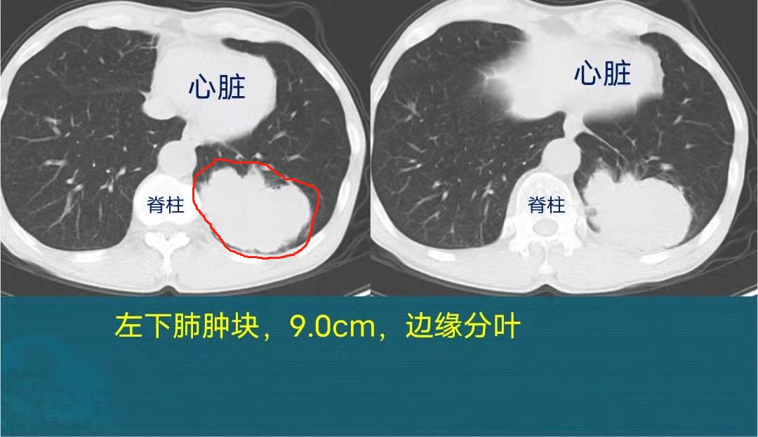 年纪大了得了肺癌怎么办,年纪轻轻得了肺癌怎么办