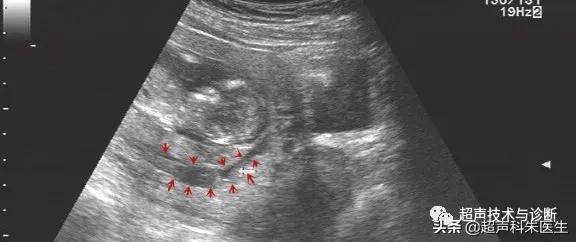 绒毛膜下血肿的超声鉴别诊断,绒毛膜下血肿的症状