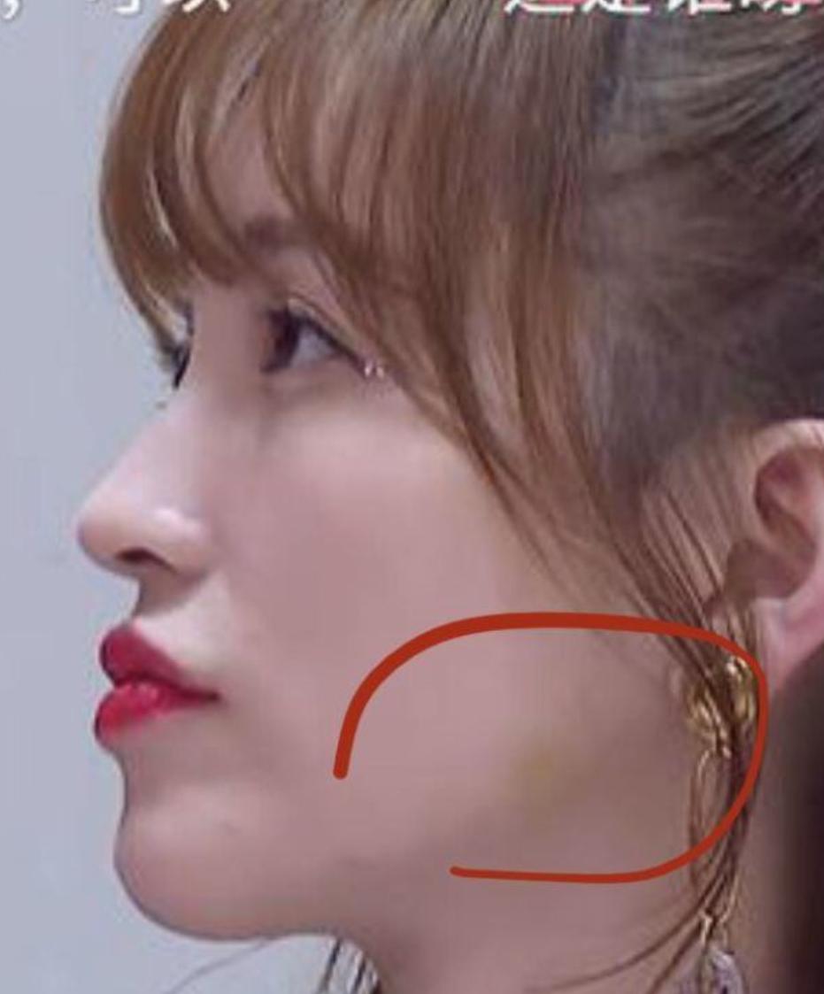 金莎谈自曝打瘦脸针,金莎打瘦脸针真实图片