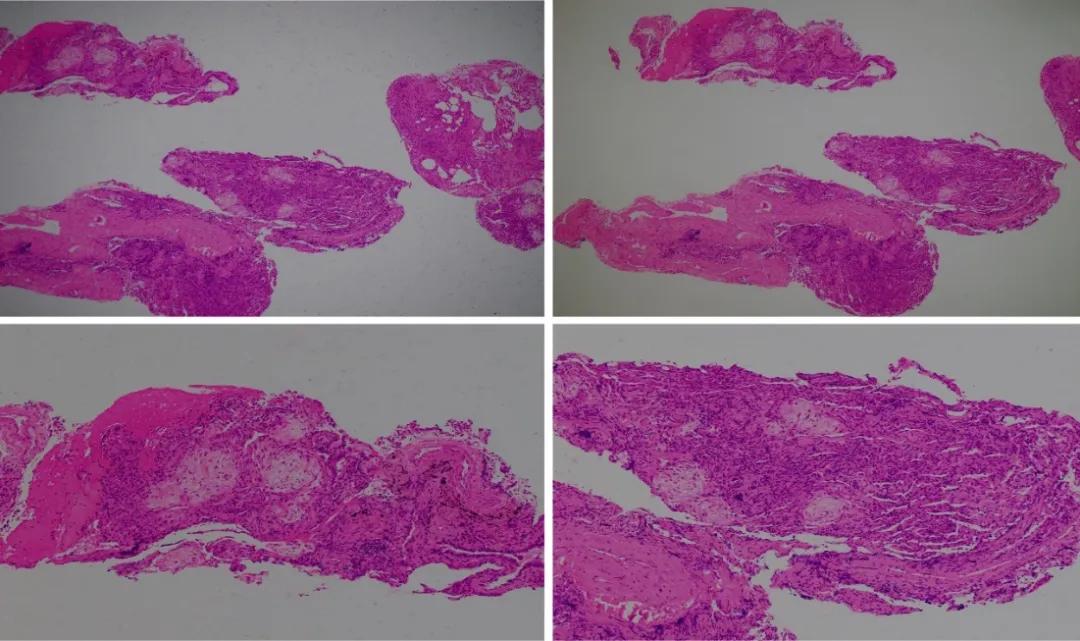 特发性肺炎一直用激素治疗,机化性肺炎住院治疗使用什么药物