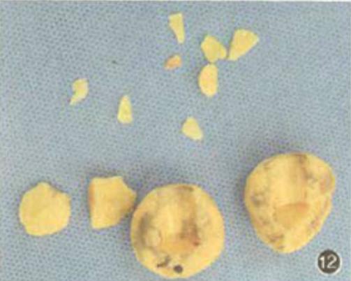 髋关节置换如何抗感染,骨科髋关节置换术后注意事项