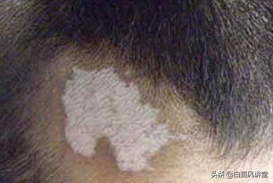 什么是毛囊型白癜风？会长满全身吗？它的发病原因是啥？