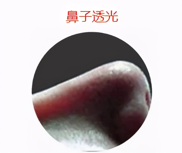 假体鼻整形手术全过程,鼻整形不满意多久可以取出假体