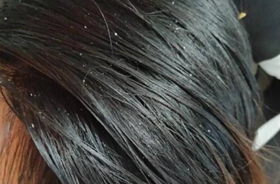 如何改善发质,发质油腻怎么改善