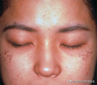 4个治疗面部色斑的方法,25岁脸部色斑怎么治