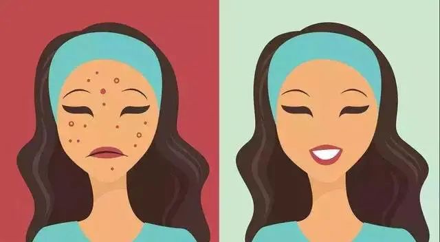 青春期月经逐渐规律的过程中长痘,青春期的痘痘来月经后会消失吗