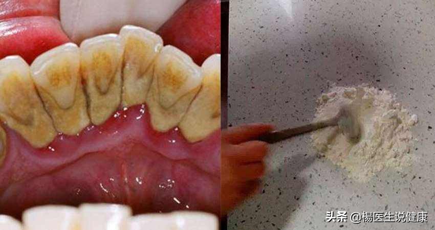 牙齿上的黄泥是什么,牙齿抠出来的东西为什么那么臭