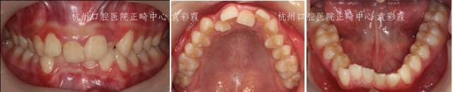 牙齿深覆合对脸型的影响,覆合型牙齿是怎么造成的